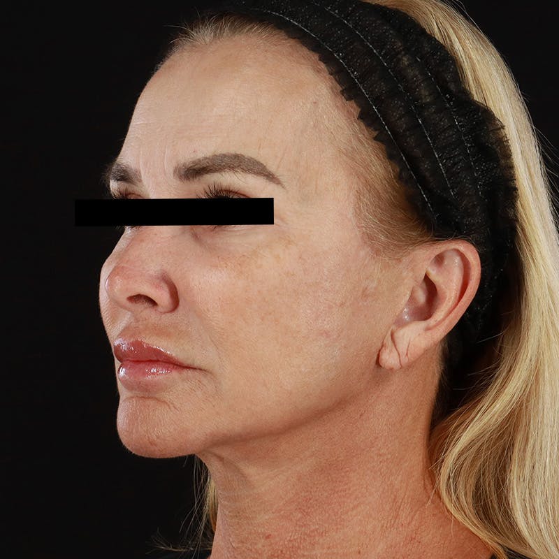 Microneedling Before & After Gallery - Patient 273381 - Image 5