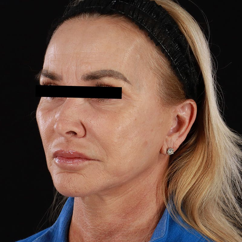 Microneedling Before & After Gallery - Patient 273381 - Image 6