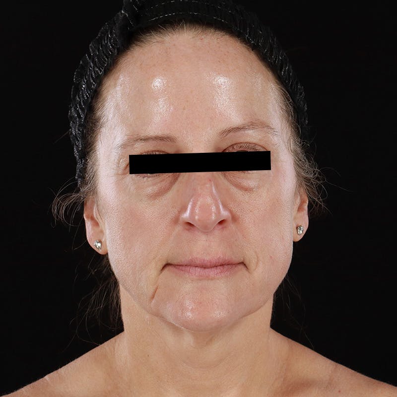 Microneedling Before & After Gallery - Patient 254715 - Image 1