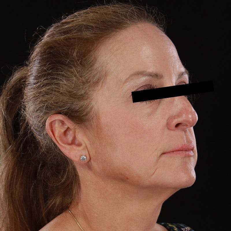Microneedling Before & After Gallery - Patient 254715 - Image 4