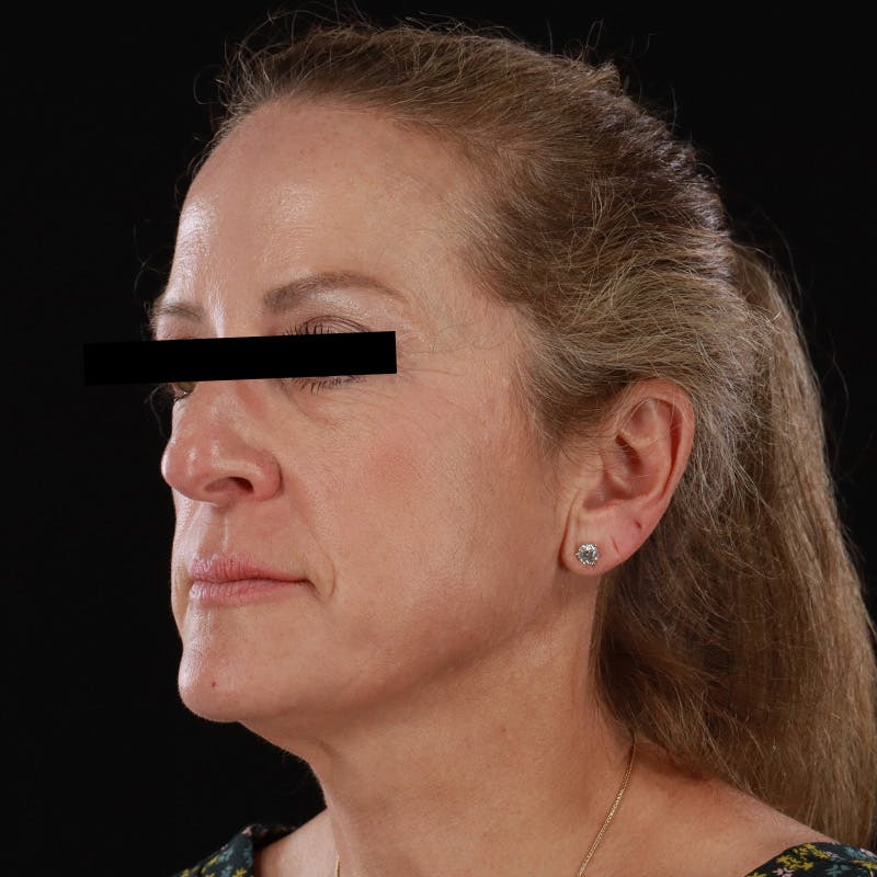 Microneedling Before & After Gallery - Patient 254715 - Image 6