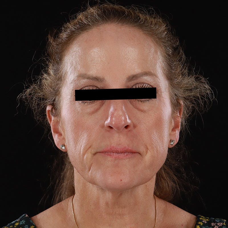 Microneedling Before & After Gallery - Patient 254715 - Image 2