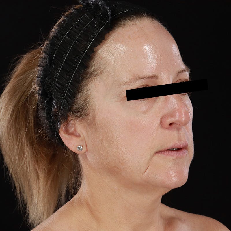 Microneedling Before & After Gallery - Patient 254715 - Image 3
