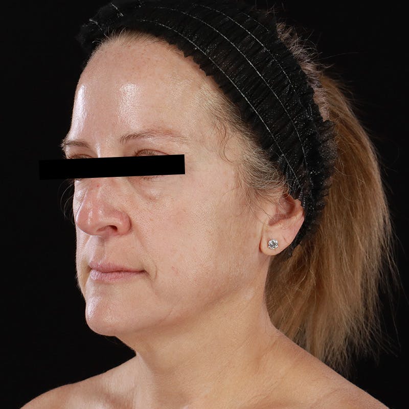 Microneedling Before & After Gallery - Patient 254715 - Image 5