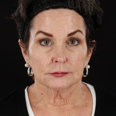 Morpheus8 Before & After Gallery - Patient 331767 - Image 1