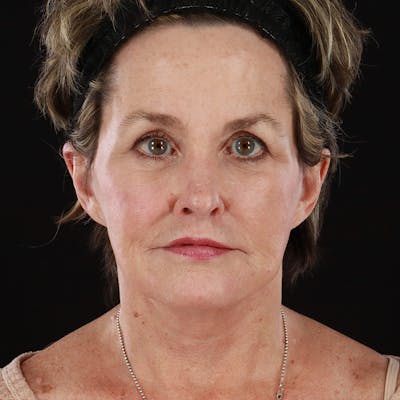 Morpheus8 Before & After Gallery - Patient 331767 - Image 2