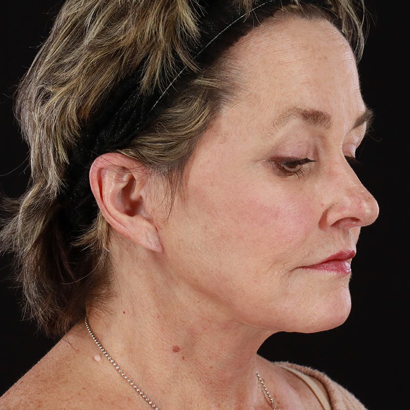 Morpheus8 Before & After Gallery - Patient 331767 - Image 4
