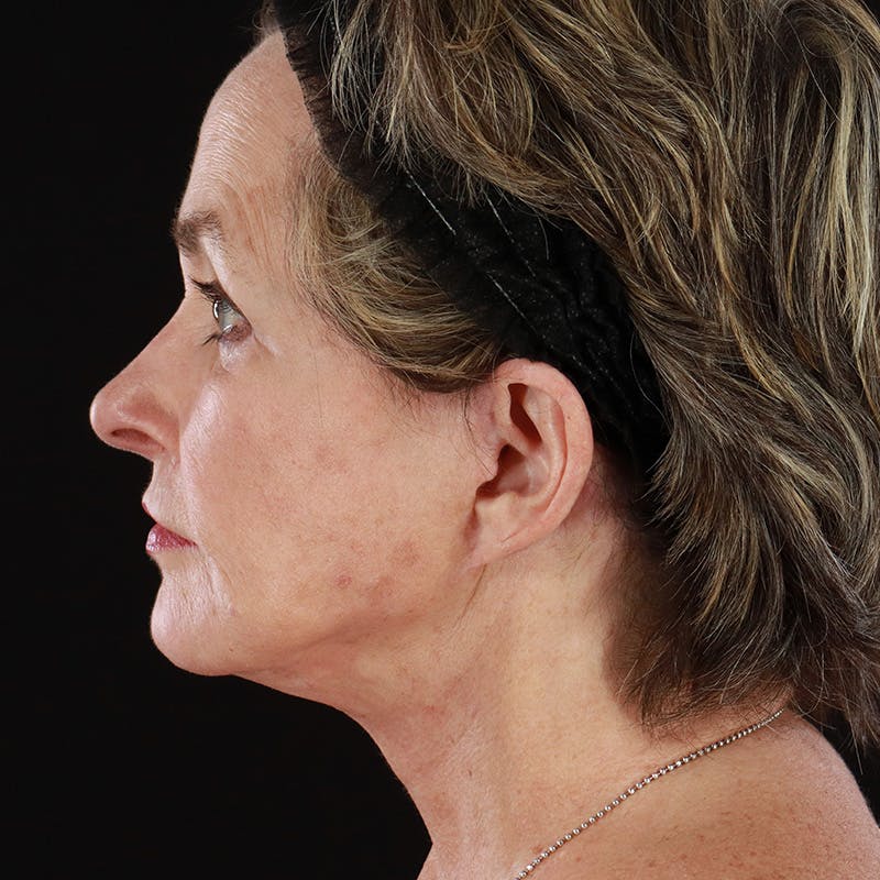 Morpheus8 Before & After Gallery - Patient 331767 - Image 6
