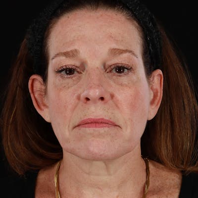 Morpheus8 Before & After Gallery - Patient 187239 - Image 1