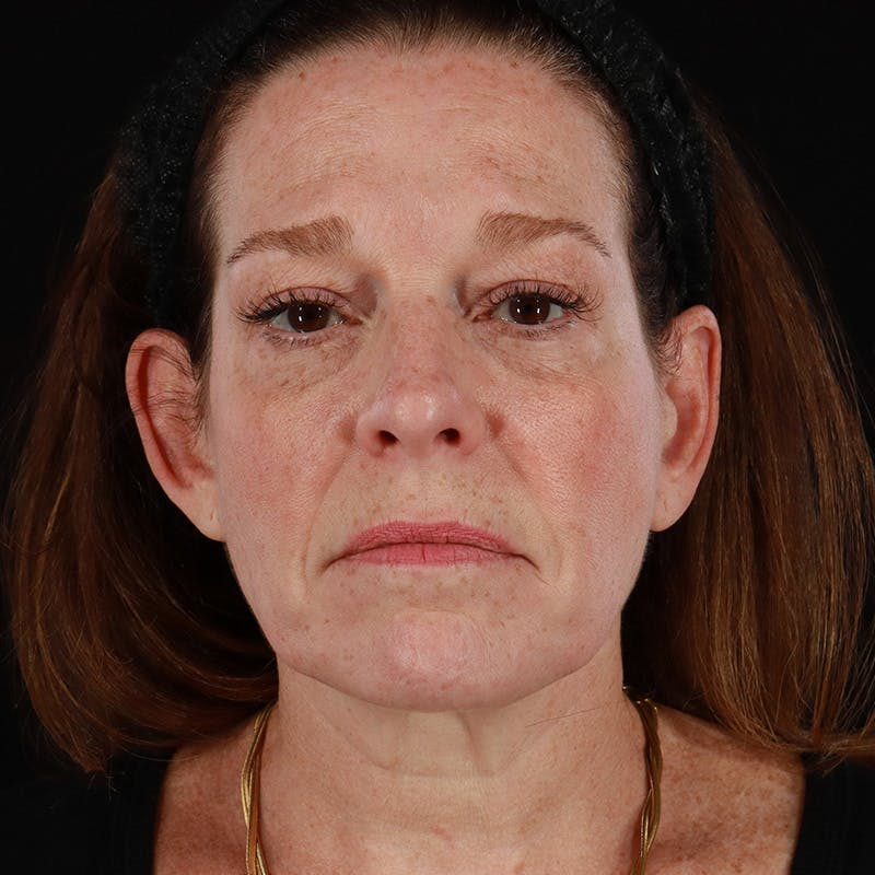 Morpheus8 Before & After Gallery - Patient 187239 - Image 1