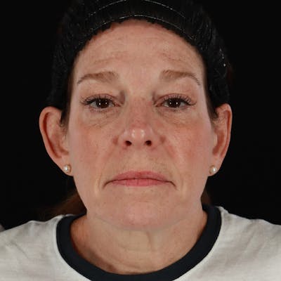 Morpheus8 Before & After Gallery - Patient 187239 - Image 2