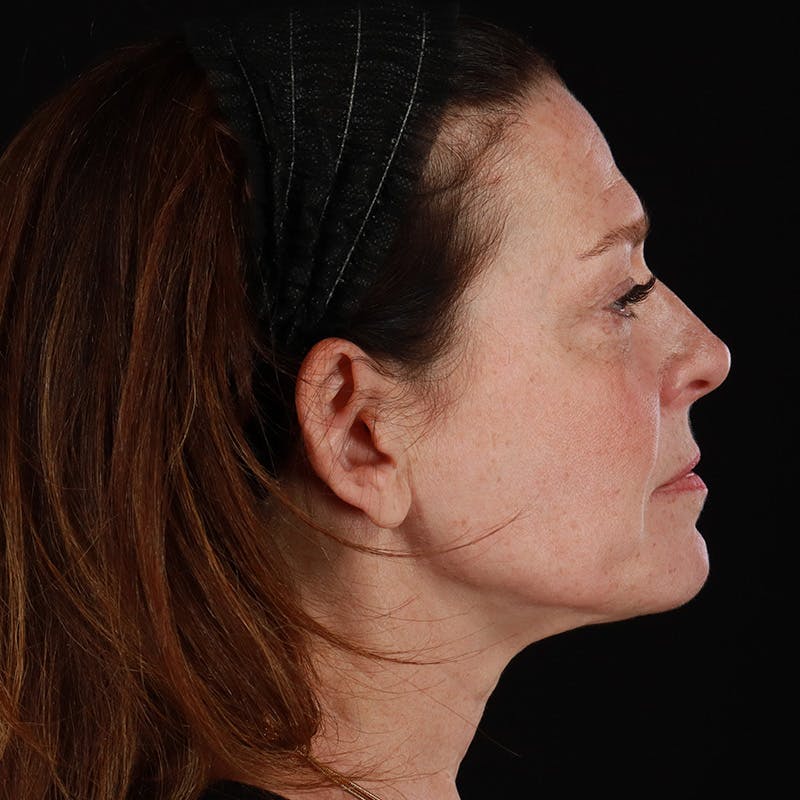 Morpheus8 Before & After Gallery - Patient 187239 - Image 7