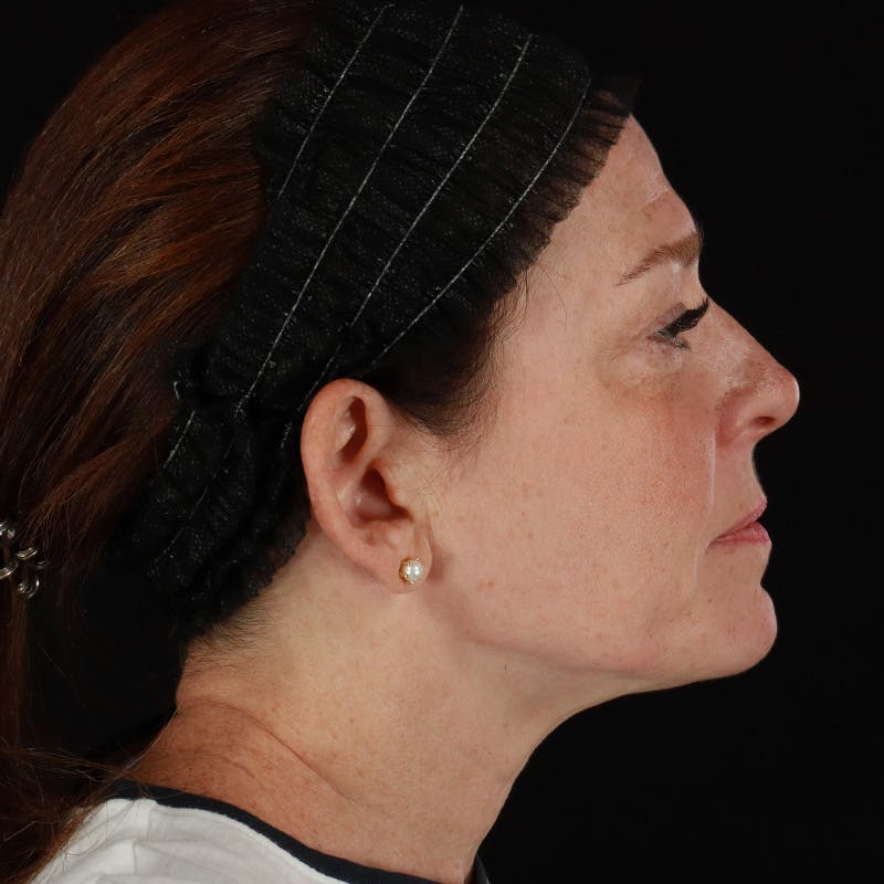 Morpheus8 Before & After Gallery - Patient 187239 - Image 8