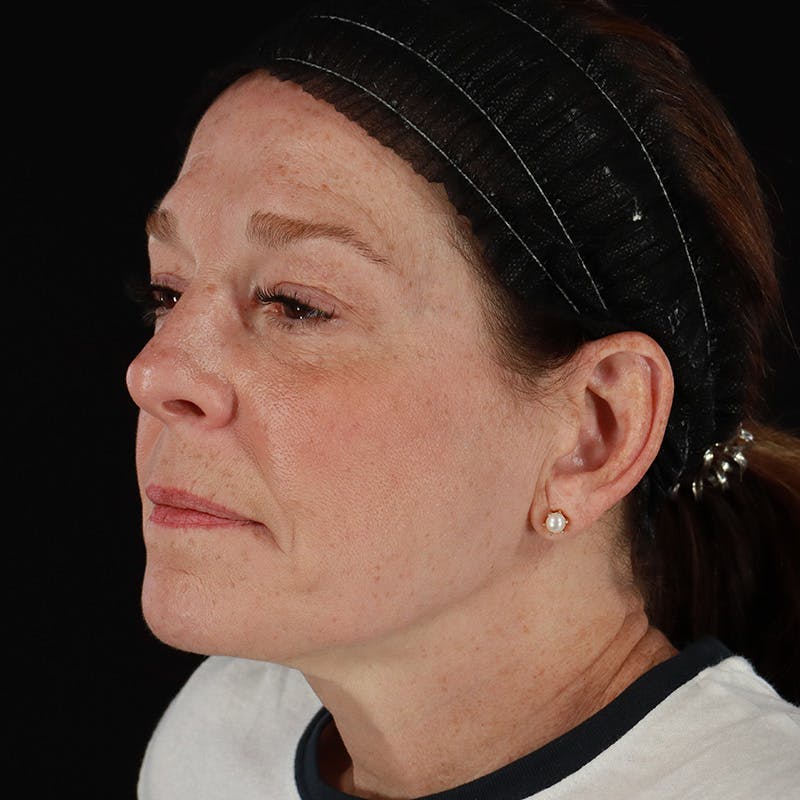 Morpheus8 Before & After Gallery - Patient 187239 - Image 4