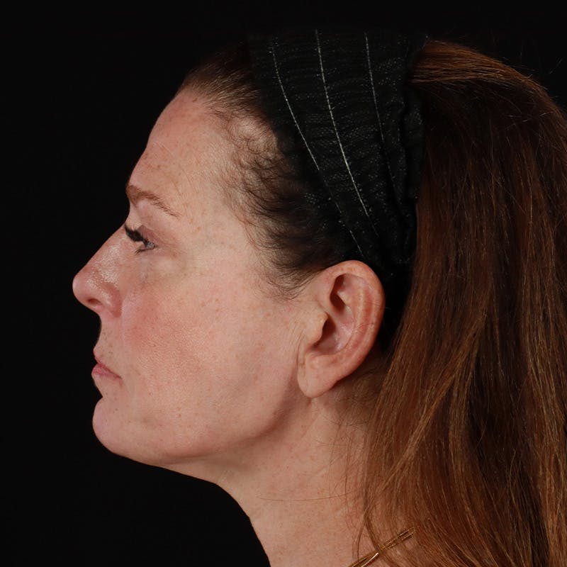 Morpheus8 Before & After Gallery - Patient 187239 - Image 5