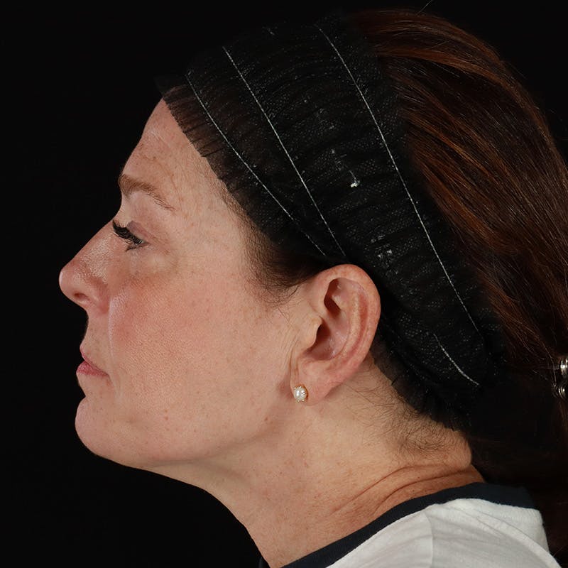 Morpheus8 Before & After Gallery - Patient 187239 - Image 6