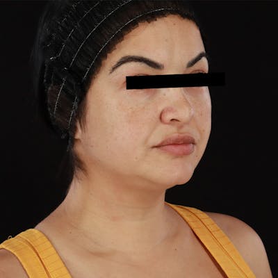 Morpheus8 Before & After Gallery - Patient 276800 - Image 1