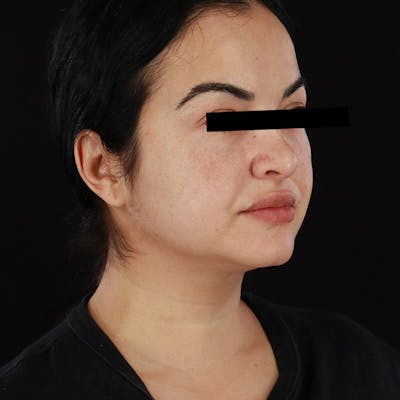 Morpheus8 Before & After Gallery - Patient 276800 - Image 2