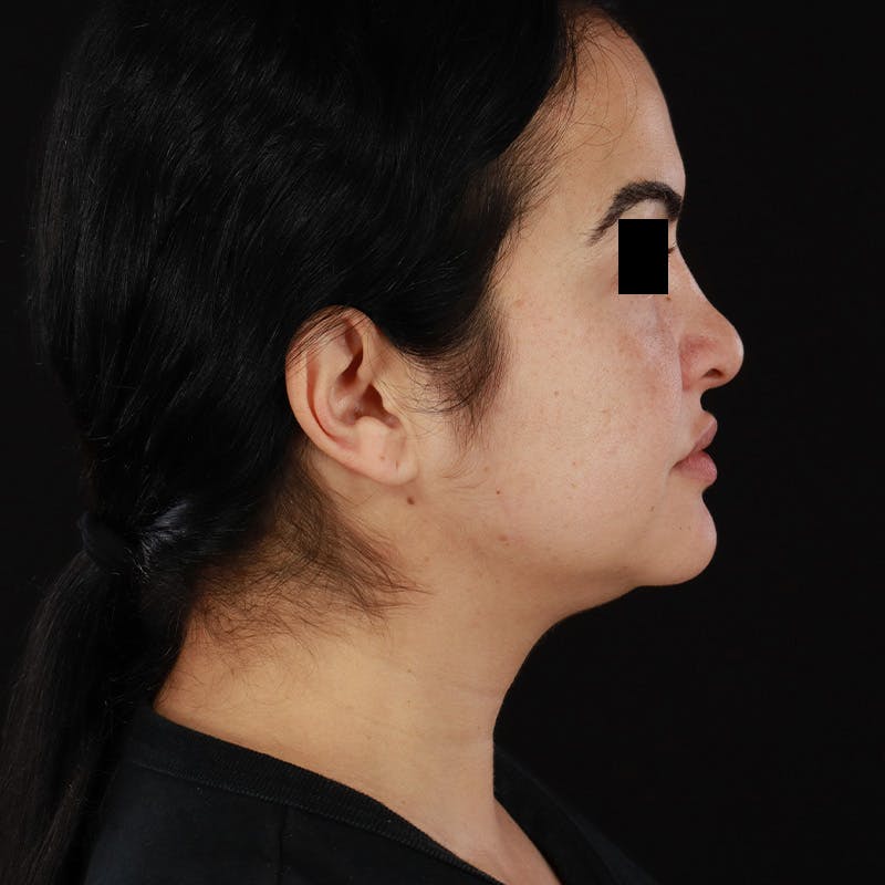 Morpheus8 Before & After Gallery - Patient 276800 - Image 4