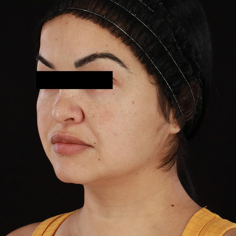 Morpheus8 Before & After Gallery - Patient 276800 - Image 5
