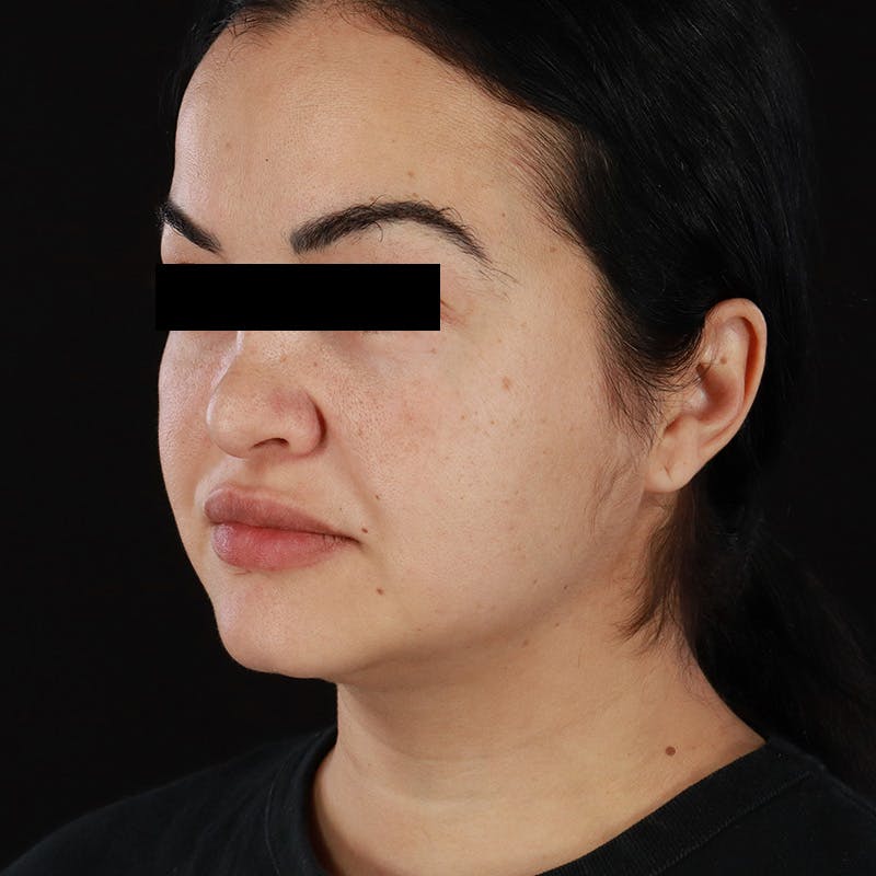 Morpheus8 Before & After Gallery - Patient 276800 - Image 6