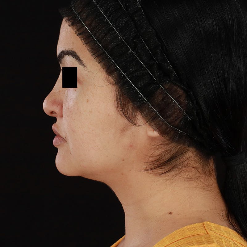 Morpheus8 Before & After Gallery - Patient 276800 - Image 7