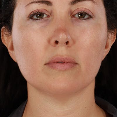 Morpheus8 Before & After Gallery - Patient 246297 - Image 1