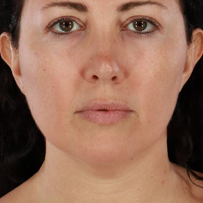 Morpheus8 Before & After Gallery - Patient 246297 - Image 2