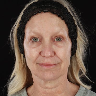 Morpheus8 Before & After Gallery - Patient 111154 - Image 1