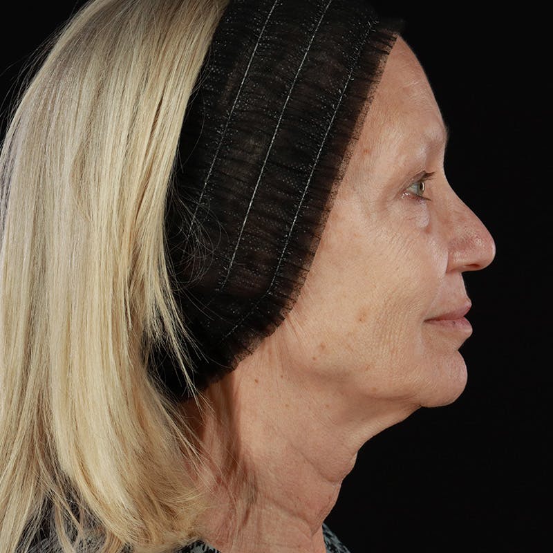 Morpheus8 Before & After Gallery - Patient 111154 - Image 5