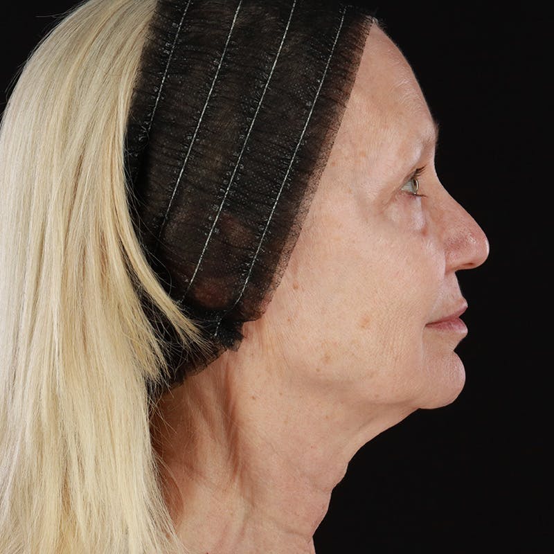 Morpheus8 Before & After Gallery - Patient 111154 - Image 6
