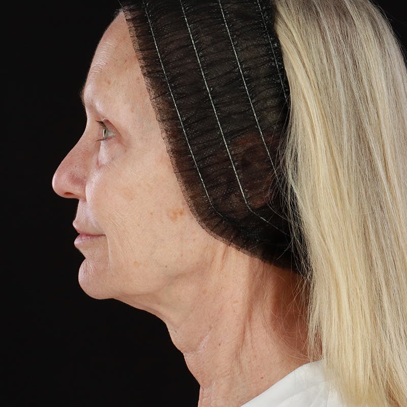 Morpheus8 Before & After Gallery - Patient 111154 - Image 10