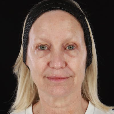 Morpheus8 Before & After Gallery - Patient 111154 - Image 2