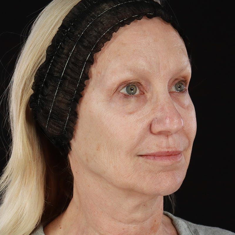 Morpheus8 Before & After Gallery - Patient 111154 - Image 3