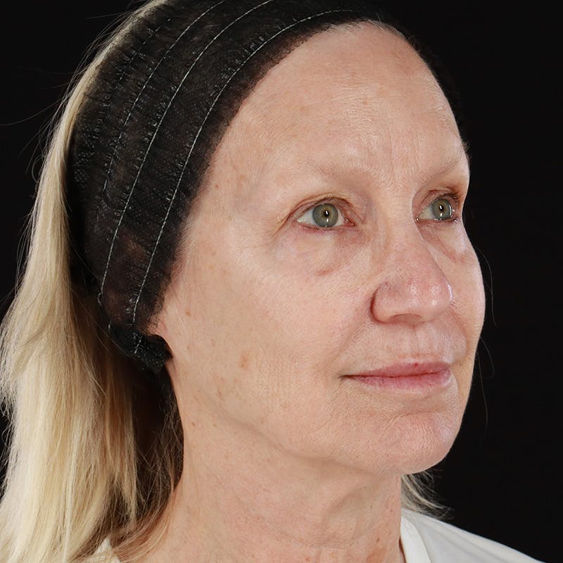 Morpheus8 Before & After Gallery - Patient 111154 - Image 4