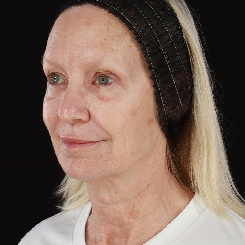 Morpheus8 Before & After Gallery - Patient 111154 - Image 8