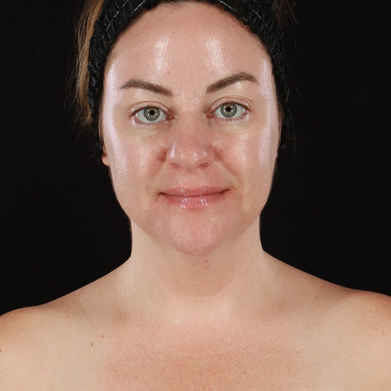 Morpheus8 Before & After Gallery - Patient 124015 - Image 2