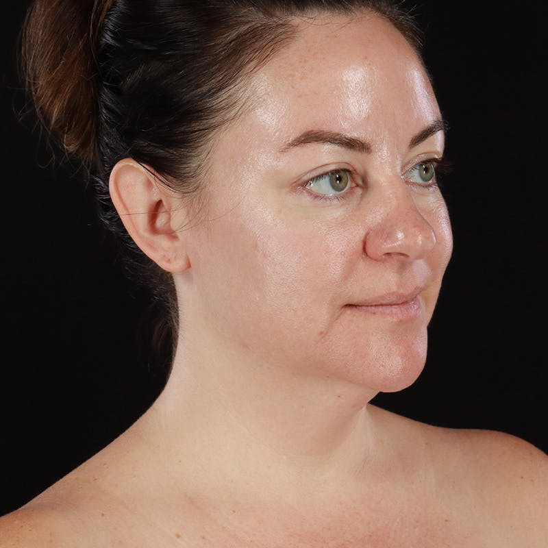 Morpheus8 Before & After Gallery - Patient 124015 - Image 3