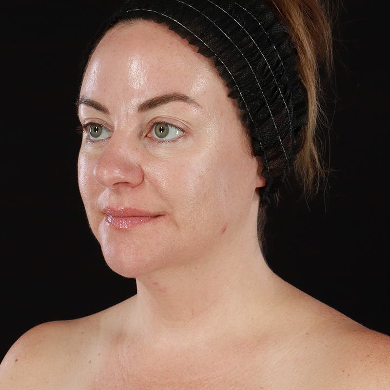 Morpheus8 Before & After Gallery - Patient 124015 - Image 8