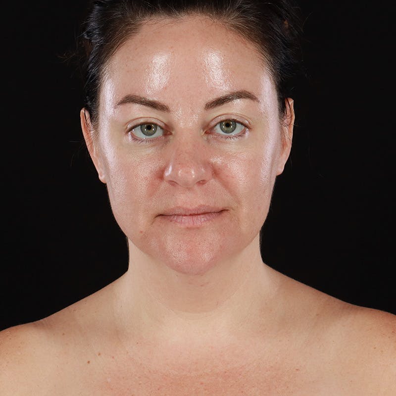Morpheus8 Before & After Gallery - Patient 124015 - Image 1