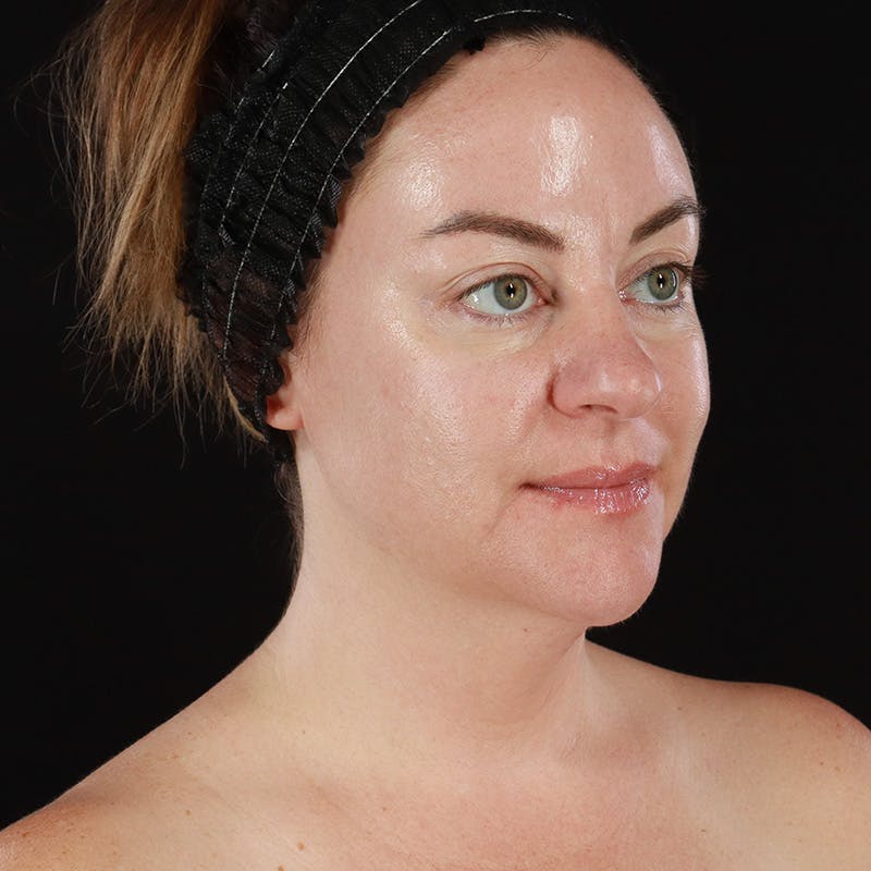 Morpheus8 Before & After Gallery - Patient 124015 - Image 4