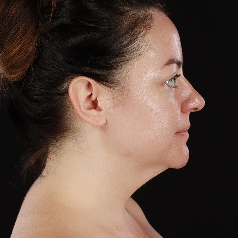 Morpheus8 Before & After Gallery - Patient 124015 - Image 5