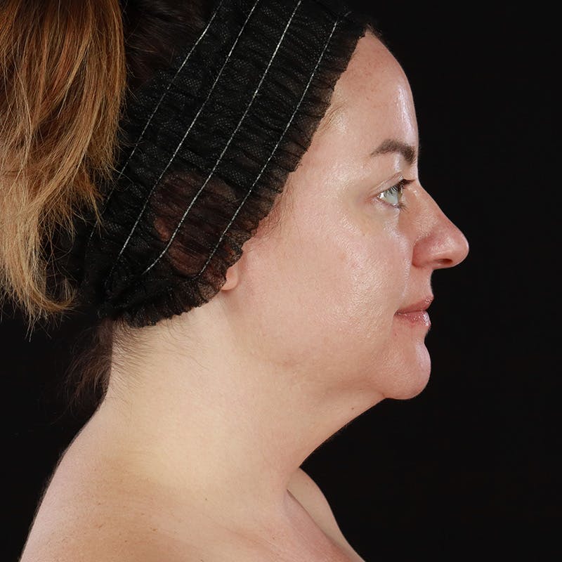 Morpheus8 Before & After Gallery - Patient 124015 - Image 6