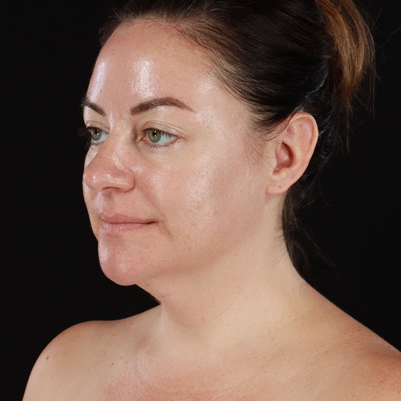 Morpheus8 Before & After Gallery - Patient 124015 - Image 7