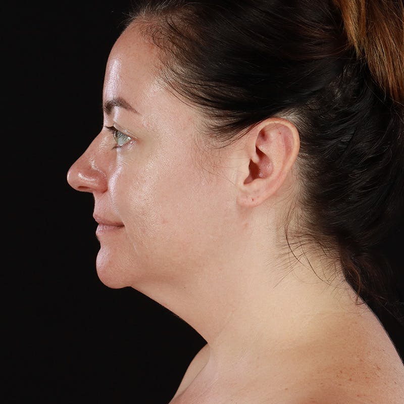 Morpheus8 Before & After Gallery - Patient 124015 - Image 9