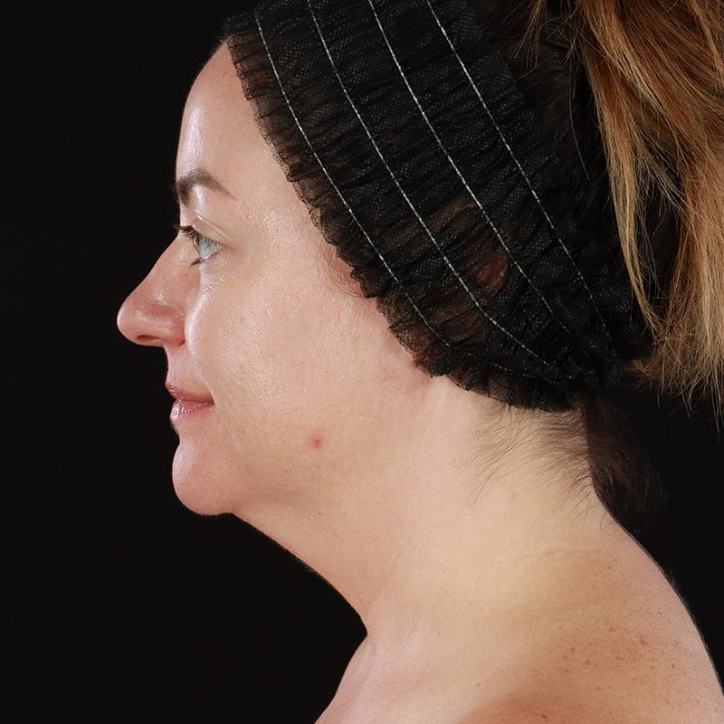 Morpheus8 Before & After Gallery - Patient 124015 - Image 10