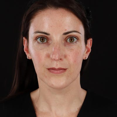 Morpheus8 Before & After Gallery - Patient 620699 - Image 1