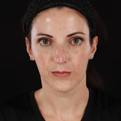 Morpheus8 Before & After Gallery - Patient 620699 - Image 2