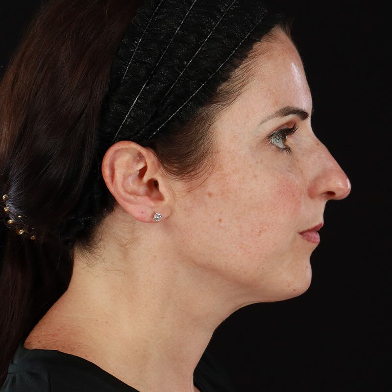 Morpheus8 Before & After Gallery - Patient 620699 - Image 6