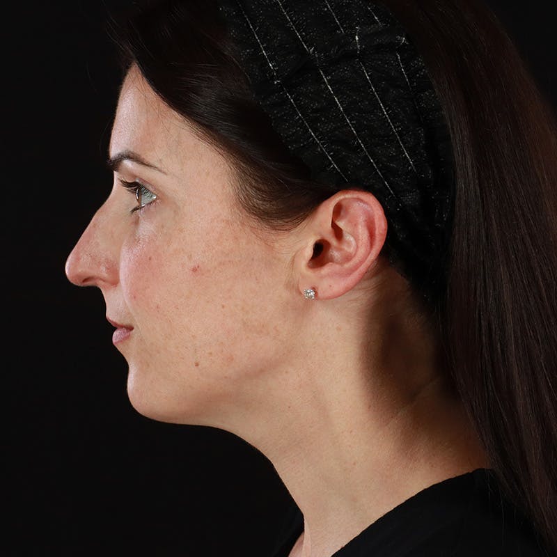 Morpheus8 Before & After Gallery - Patient 620699 - Image 9